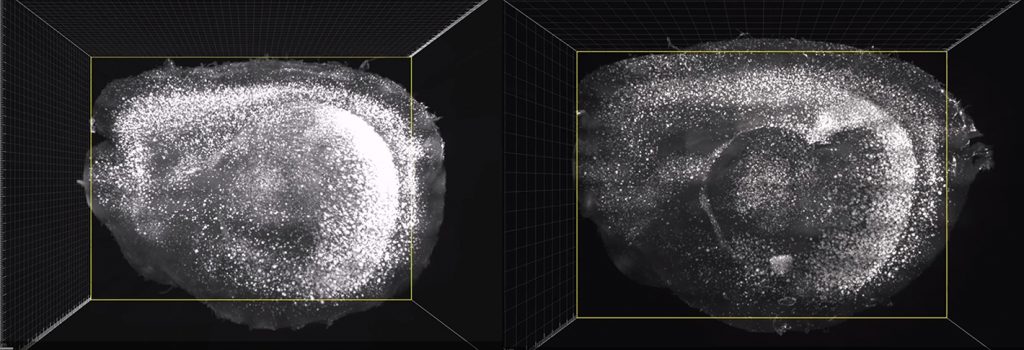 In mouse brains stained for the presence of amyloid, much less is visible in the cortex of a mouse treated with sensory gamma stimulation (right) than in a mouse left untreated (left).